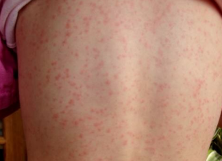 Scarlet fever is back and every parent needs to watch out for these warning signs